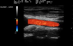 Duplex Sonographie der Halsschlagader